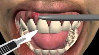 How to treat a tooth abscess