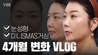 피부 처짐 때문에 고민이라면? 성형 후 4개월 변화 직접 보여드립니다!