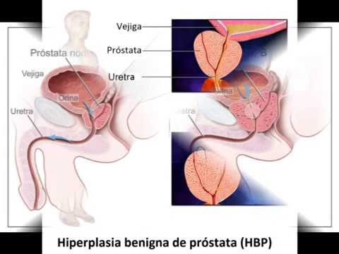 Come aiutare i semi di prostatite Trattamento di sintomi di rimedi popolari prostatite