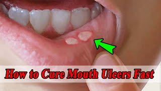 How to Cure Mouth Ulcers Fast with 10 Home Remedies?
