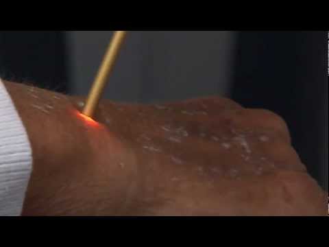 Altersfleckenentfernung mit dem Rubinlaser