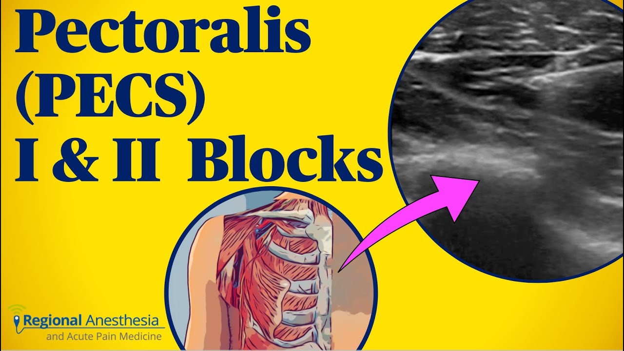 Pectoralis (PECS) blocks I & II Pectoralis (PECS) blocks I & II