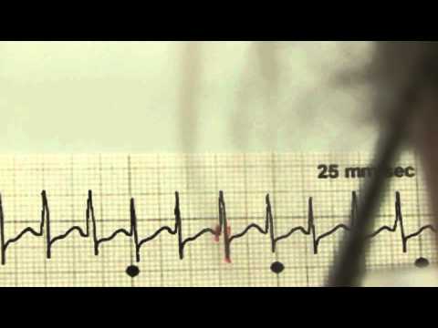 EKG für Pflege Teil 19 - Supraventrikuläre Tachykardie interpretieren