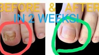 Kerasal - #1 in Fungal Nail Removal. Toenails & Figure Nails. IT WORKS! HowTO Get Rid of Nail Fungus