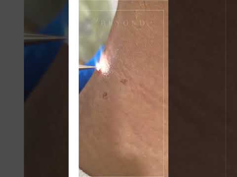 Wart Removal Treatment 
