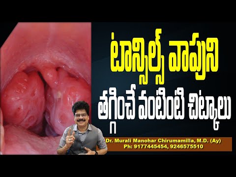 టాన్సిల్స్ వాపుని తగ్గించే వంటింటి చిట్కాలు!Home Remedies For Tonsillitis (Inflamed Tonsils)