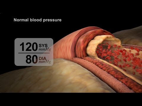 High Blood Pressure Diagnosis | NUCLEUS Medical Media
