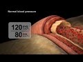 High Blood Pressure Diagnosis NUCLEUS Medical Media