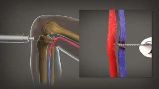 7-Figure Settlement: Leg Amputated After Blood Vessels Damaged During Knee Replacement