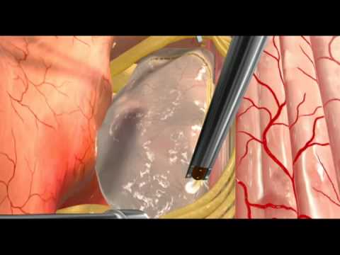 Animation - Spinal Cord Intramedullary Tumor.mov