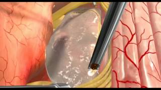Spine Tumour SurgeryVideo In India Spine Tumour SurgeryVideo In India