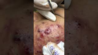 Mụn thành 17t part7(spa hải Âu) Mụn thành 17t part7(spa hải Âu)