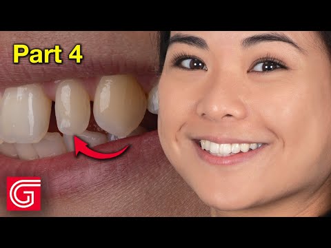 How To Bond All-Ceramic Crown for Peg Lateral Tooth 10