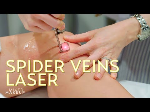 We Tried a Spider Veins Laser Treatment! | The SASS with Susan and Sharzad Video