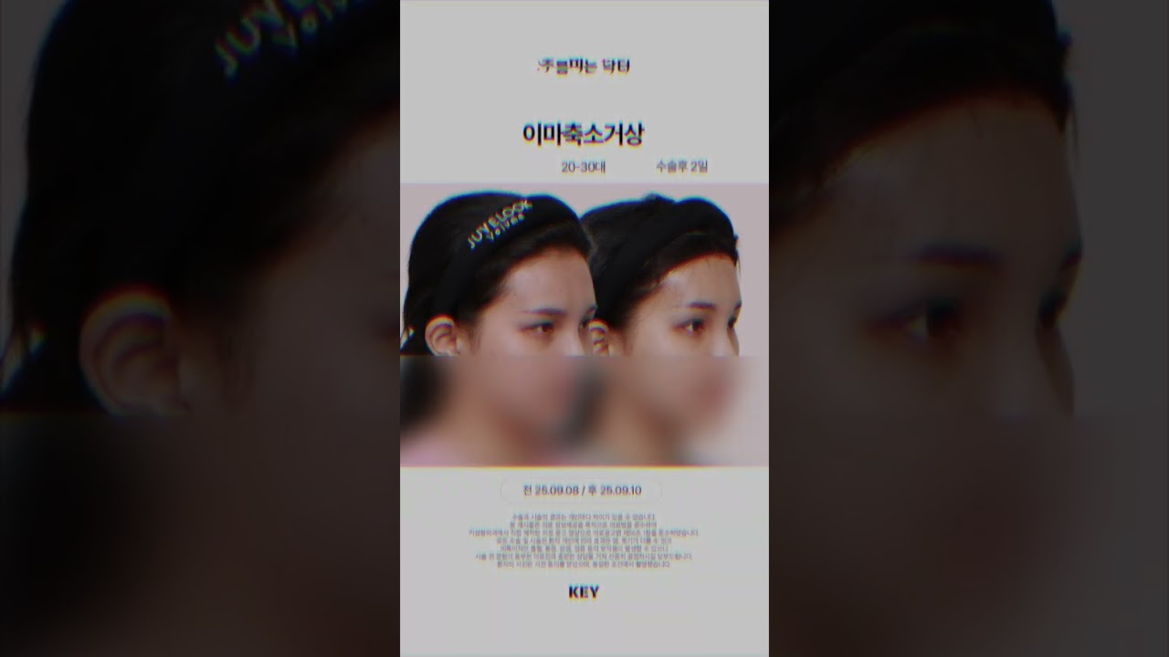 20대 이마축소거상