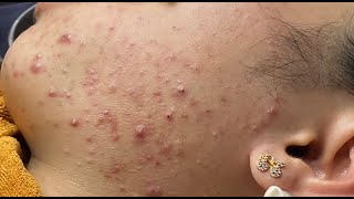Blackhead & Whitehead Extractions (P.1) #HoangMySpa176