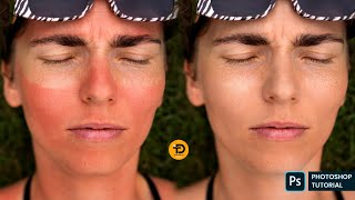 How To Remove Sunburn In Photoshop | Fix Red Skin Tone Photoshop Tutorial