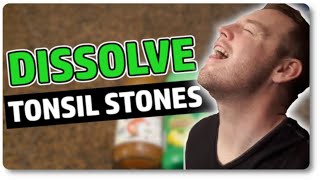 Dissolve Tonsil Stones At Home With Only 3 Ingredients