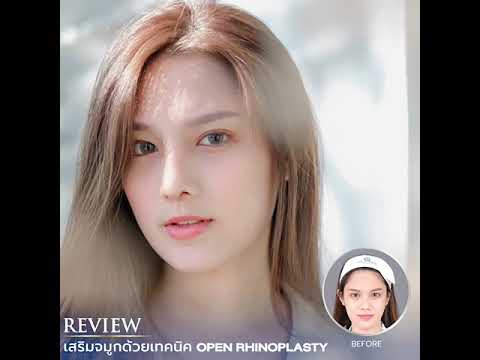 เสริมจมูกเทคนิคโอเพ่น ที่ Dr. Chen Clinic เสริมจมูกเทคนิคโอเพ่น ที่ Dr. Chen Clinic