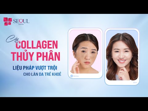 Khách Hàng Hiền Mai Nói Gì Sau Khi Cấy Collagen Thủy Phân