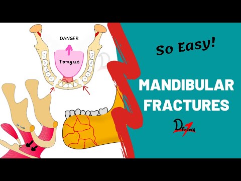Mandibular Fractures | Basics 