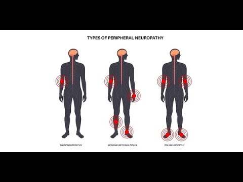 Мононевропатии и полиневропатии; различные модели заболеваний периферических нервов