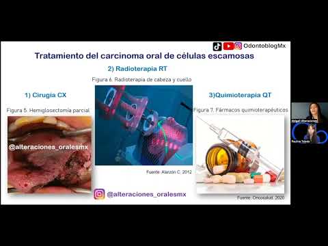 Carcinoma Oral de Células Escamosas