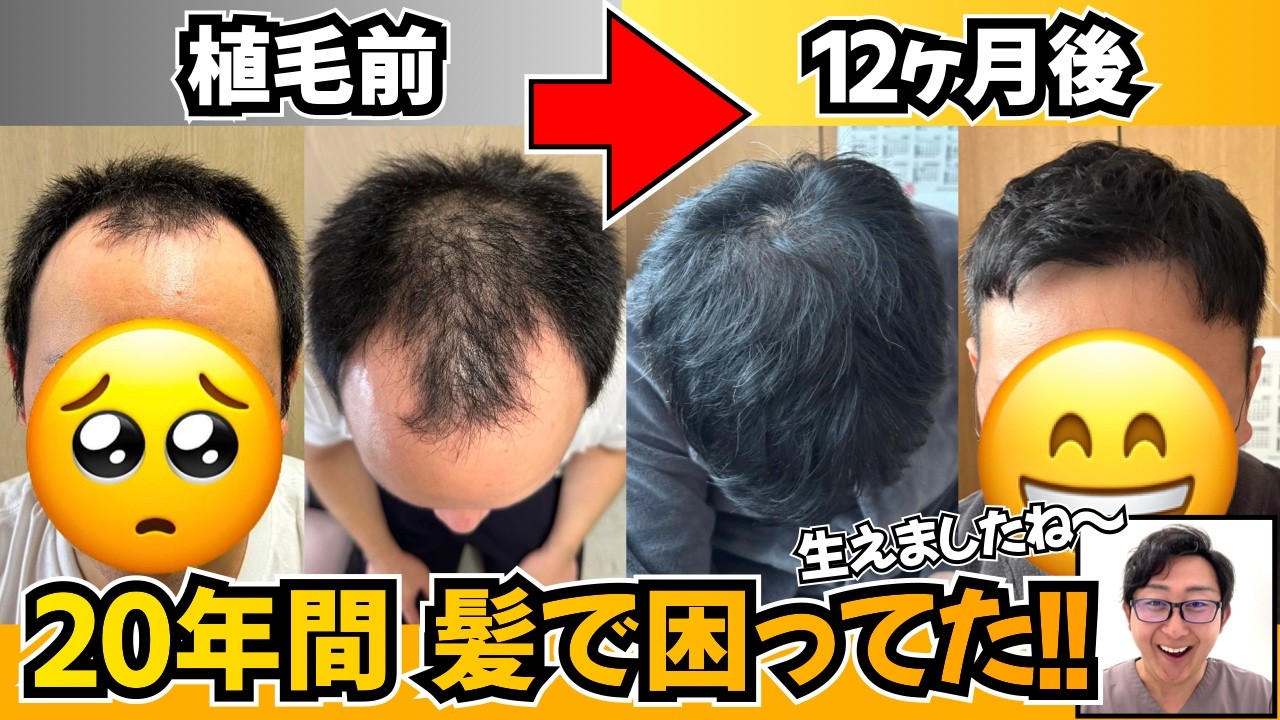 【髪回復】中学生の頃から髪に悩んでました。。。【自毛植毛｜体験談】