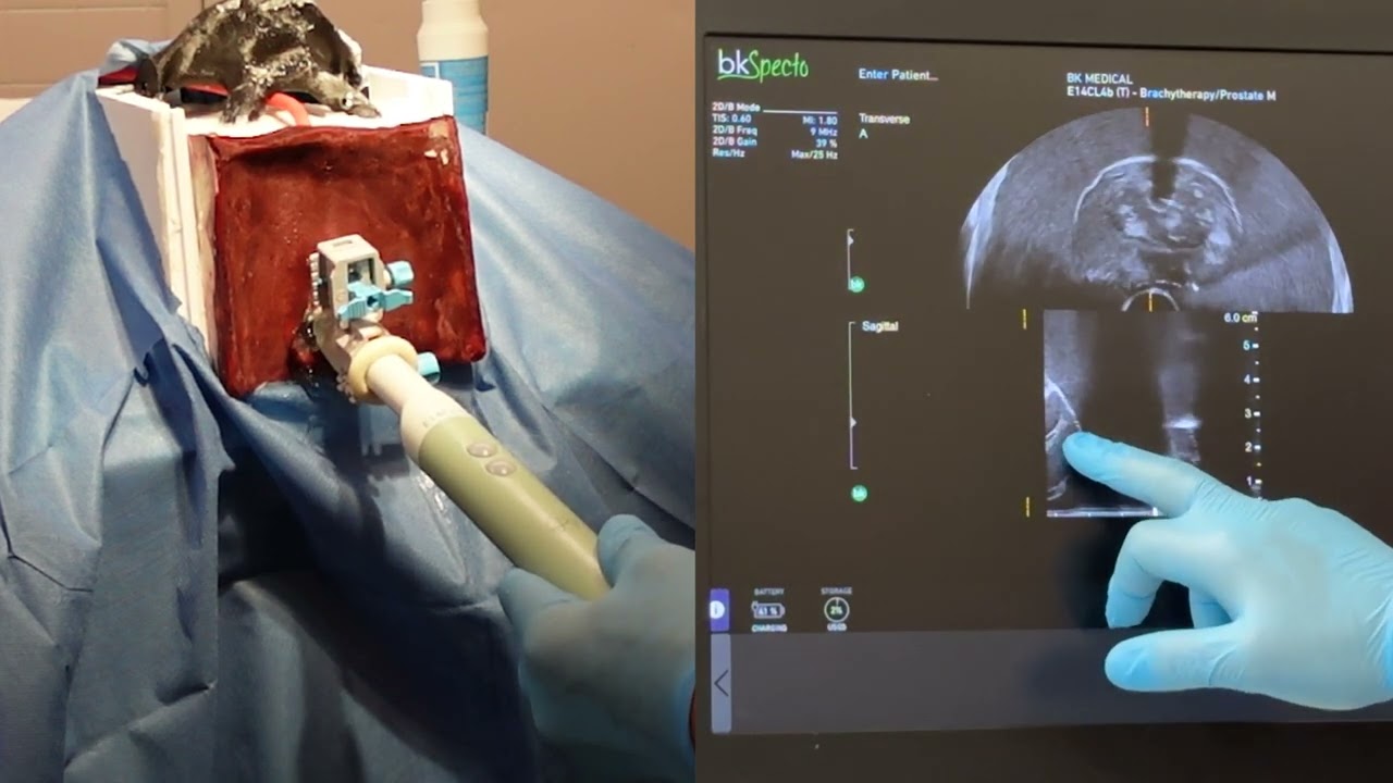 Local Anesthesia Transperineal Prostate Biopsy Simulation