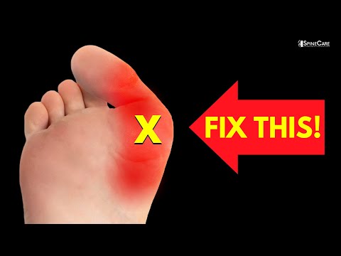 The BEST Exercises to Relieve Bunion Pain