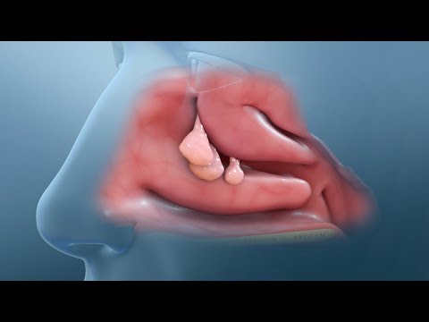 Nasal Polyp Removal Surgery
