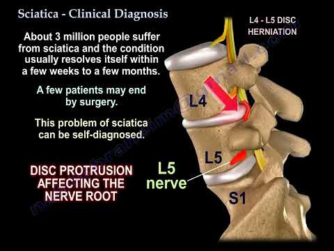 Sciatica causes, Clinical Diagnosis  and treatment.