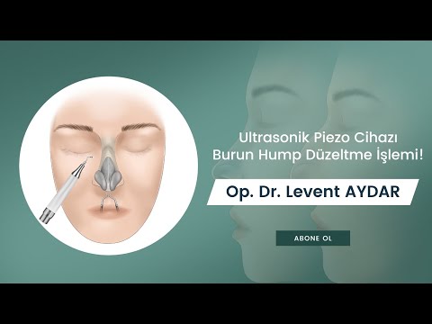 Rinoplasti ameliyatı | Burun hamp düzeltme | Op. Dr. Levent Aydar