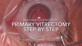 Surgical steps - Primary pars plana vitrectomy for rhegmatogenous retinal detachment
