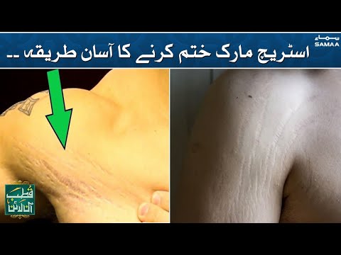 How to get rid of Stretch marks? | Qutb Online | SAMAA TV