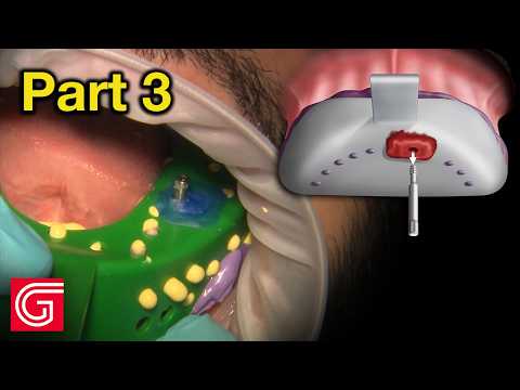 Socket Preservation with PRF — Complete Protocol