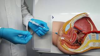 Igenomix - Cómo realizar una biopsia líquida de endometrio