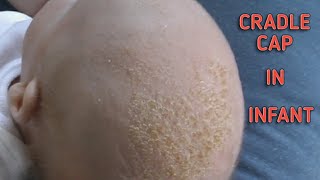 What to do if your baby is having Cradle Cap?