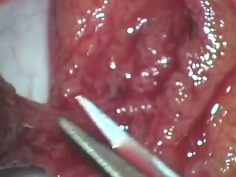 Trattamento della prostata radice di bardana Sintomi di adenoma prostatico