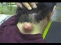 BIGGEST ZIT ON PLANET EARTH!!! (warning! MOST ...