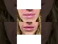 Creating a crisp vermillion border, adding volume to the lips, and softening the nasolabial folds!