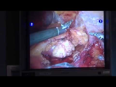 Dapoxetin bei Vesikulitis Fibrosen der Prostata