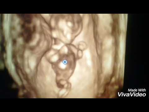 Feto 12 semanas evaluación en 4D