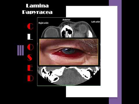 Nose radiology series (14); The lamina papyracea (10)