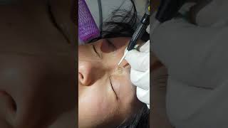 Mole Removal Sydney CBD | Arsy Health Sydney