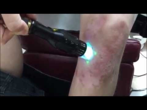 Come guarire la dermatite atopic su labbra Punga la cura diprospan di psoriasi