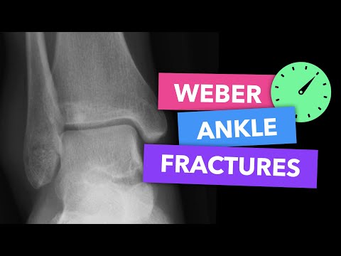 Weber Ankle Fractures - Radiopaedia's Emergency Radiology Course