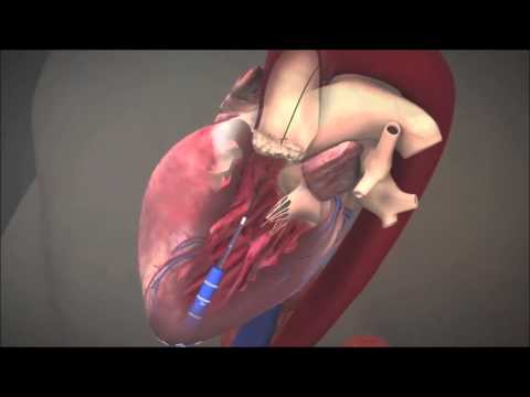TA Procedure（TAVI 経心尖アプローチ）
