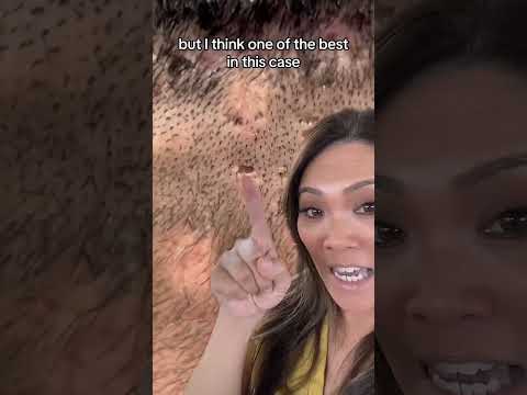 This is one of 5 types of acne scars