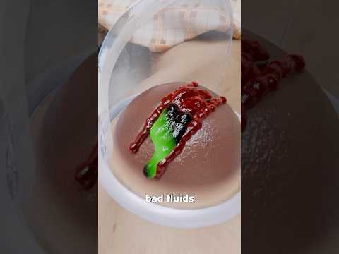 How This Suction Cup Therapy Works 🤔 Surgeon Reacts